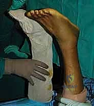 إغلاق غلاف الوتر Paratenon