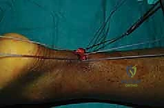 التقاء الخيوط العلوية والسفلية