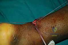 إحكام العقد الجراحية