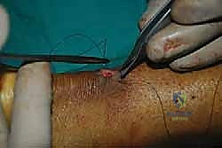 صورة توضيحية لـ إصلاح وتر أخيل بالحد الأدنى للتدخل الجراحي: دليل شامل للمرضى