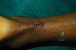 صورة توضيحية لـ إصلاح وتر أخيل بالحد الأدنى للتدخل الجراحي: دليل شامل للمرضى