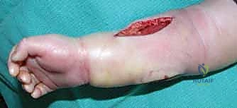 Upper Extremity Burn & Contracture Reconstruction: An Intraoperative Masterclass
