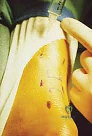 البروفيسور محمد هطيف أثناء الفحص