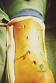 إصلاح وتر العرقوب بالحد الأدنى من التدخل الجراحي: دليلك الشامل للتعافي مع الأستاذ الدكتور محمد هطيف