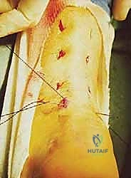 إغلاق الشقوق الجراحية