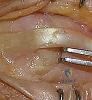 Illustration of proper collateral ligaments - Dr. Mohammed Hutaif