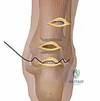 صورة توضيحية لـ إتقان إصلاح وتر أخيل بالمنظار: دليلك الشامل مع الأستاذ الدكتور محمد هطيف في صنعاء