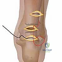أسباب وعوامل خطر تمزق وتر أخيل