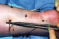 التقنيات الحديثة في تمرير الخيوط الجراحية حول وتر أخيل