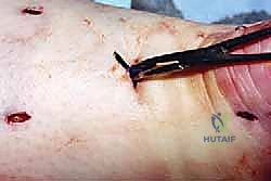 صورة توضيحية لـ إتقان إصلاح وتر أخيل بالمنظار: دليلك الشامل مع الأستاذ الدكتور محمد هطيف في صنعاء