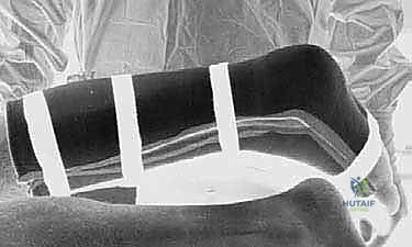 صورة توضيحية لـ إتقان إصلاح وتر أخيل بالمنظار: دليلك الشامل مع الأستاذ الدكتور محمد هطيف في صنعاء