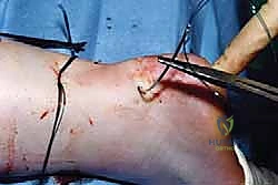 إتقان إصلاح وتر أخيل بالمنظار: دليلك الشامل مع الأستاذ الدكتور محمد هطيف في صنعاء