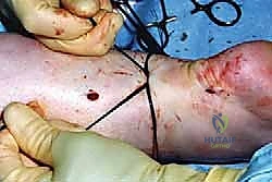 صورة توضيحية لـ إتقان إصلاح وتر أخيل بالمنظار: دليلك الشامل مع الأستاذ الدكتور محمد هطيف في صنعاء