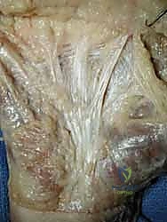 تطور العقد الليفية في راحة اليد نتيجة العوامل المختلفة