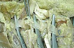 الفحص السريري الدقيق لمرض دوبويتران في عيادة الدكتور هطيف