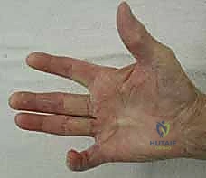 عملية استئصال تليف دوبويتران: استعادة مرونة اليد ووظيفتها مع الأستاذ الدكتور محمد هطيف في صنعاء