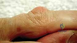 تحديد مسار الشق الجراحي في راحة اليد بتقنية Z-plasty