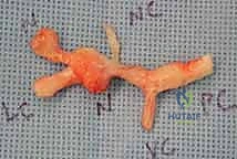 صورة توضيحية لـ عملية استئصال تليف دوبويتران: استعادة مرونة اليد ووظيفتها مع الأستاذ الدكتور محمد هطيف في صنعاء