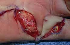 استعادة مرونة اليد بعد جراحة دوبويتران الدقيقة