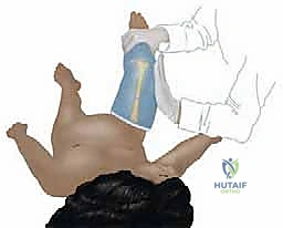 متابعة التحام عظم الفخذ بعد الجبيرة