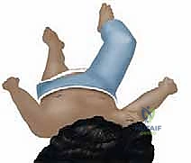 Surgical technique step for Closed Reduction and Spica Casting of Femur Fractures