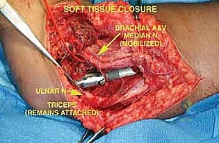 Intraoperative Surgical Step