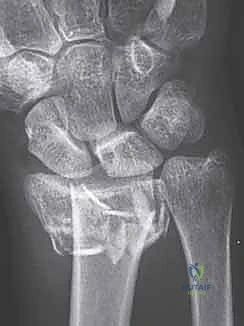 Illustration of tubercle of lister - Dr. Mohammed Hutaif
