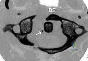 Cervical Masterclass: Posterior C1-C2 Fusion with Transarticular and Articular Mass Fixation