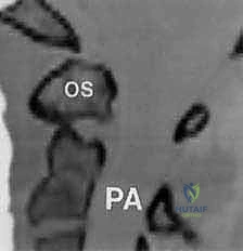 تشريح الفقرة العنقية الأولى C1