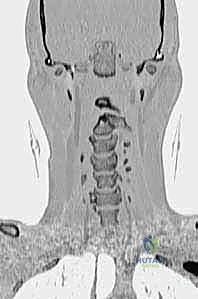 تشريح الفقرة العنقية الثانية C2 والنتوء السني