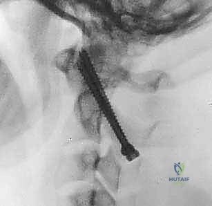 تحديد مسار المسمار في الفقرة C1