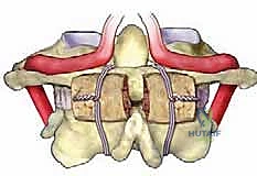 تثبيت الفقرات العنقية C1-C2: الحل الجراحي المتقدم لاستقرار الرقبة في صنعاء مع الأستاذ الدكتور محمد هطيف
