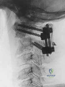 تفاصيل التثبيت بالمسامير والقضبان