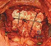 صورة توضيحية لـ تثبيت الفقرات العنقية C1-C2: الحل الجراحي المتقدم لاستقرار الرقبة في صنعاء مع الأستاذ الدكتور محمد هطيف