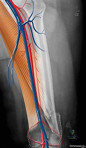 ABOS Part I Orthopaedic Trauma Review: Monteggia, Humerus Fractures & Surgical Approaches | Part 22151