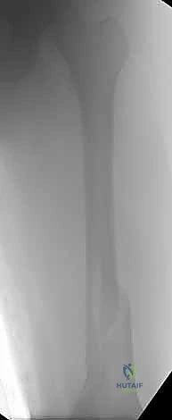 كسر بسبب هشاشة العظام