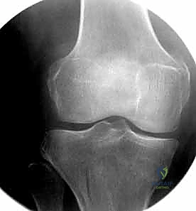 صورة طبية: كسور عظم الفخذ البعيدة: دليل شامل للعلاج والتعافي مع الأستاذ الدكتور محمد هطيف