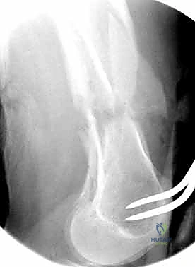 صورة طبية: كسور عظم الفخذ البعيدة: دليل شامل للعلاج والتعافي مع الأستاذ الدكتور محمد هطيف
