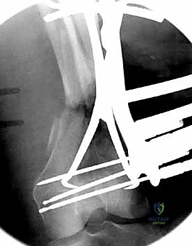 صورة طبية: كسور عظم الفخذ البعيدة: دليل شامل للعلاج والتعافي مع الأستاذ الدكتور محمد هطيف