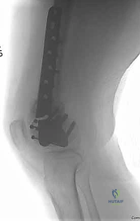 Illustration of distal femur fracture - Dr. Mohammed Hutaif