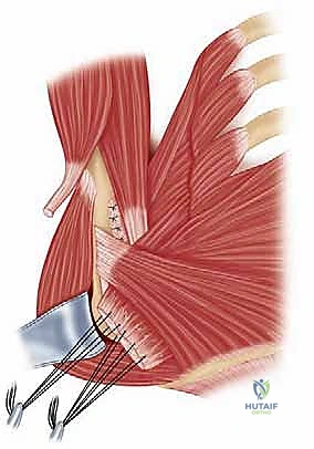 Intraoperative Surgical Step
