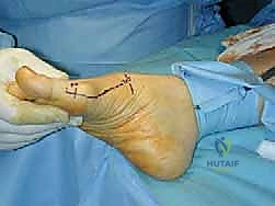 صورة توضيحية لـ عملية قطع عظم شيفرون الداني بالصفيحة المغلقة: حل جذري لإبهام القدم الأروح