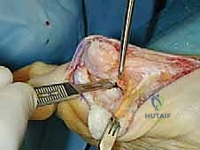 صورة توضيحية لـ عملية قطع عظم شيفرون الداني بالصفيحة المغلقة: حل جذري لإبهام القدم الأروح