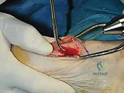 صورة توضح أعراض وتطور إبهام القدم الأروح