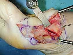 صورة توضح الأشعة السينية والتشخيص لإبهام القدم الأروح