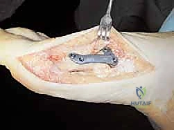 صورة توضح أسباب إبهام القدم الأروح