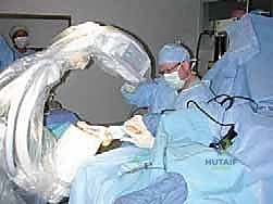 صورة توضيحية لـ عملية قطع عظم شيفرون الداني بالصفيحة المغلقة: حل جذري لإبهام القدم الأروح