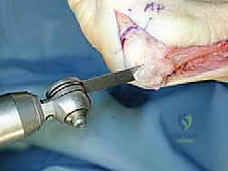 صورة توضح مفهوم قطع شيفرون الداني