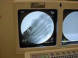 صورة توضيحية لـ عملية قطع عظم شيفرون الداني بالصفيحة المغلقة: حل جذري لإبهام القدم الأروح