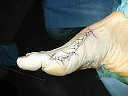 Proximal Chevron Osteotomy with Locking Plate Fixation for Hallux Valgus Correction